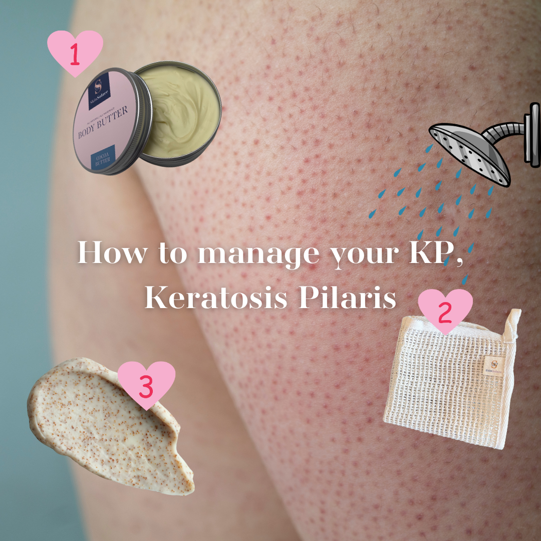 What is Keratosis Pilaris and How To  Manage It