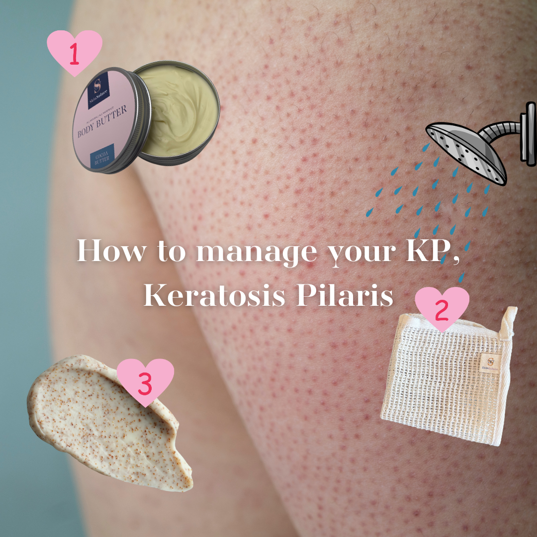 Keratosis Pilaris